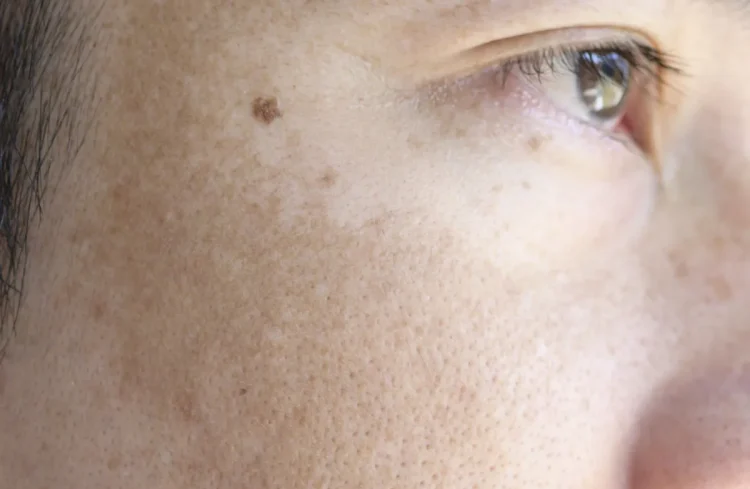 Melasma-e1720709884785